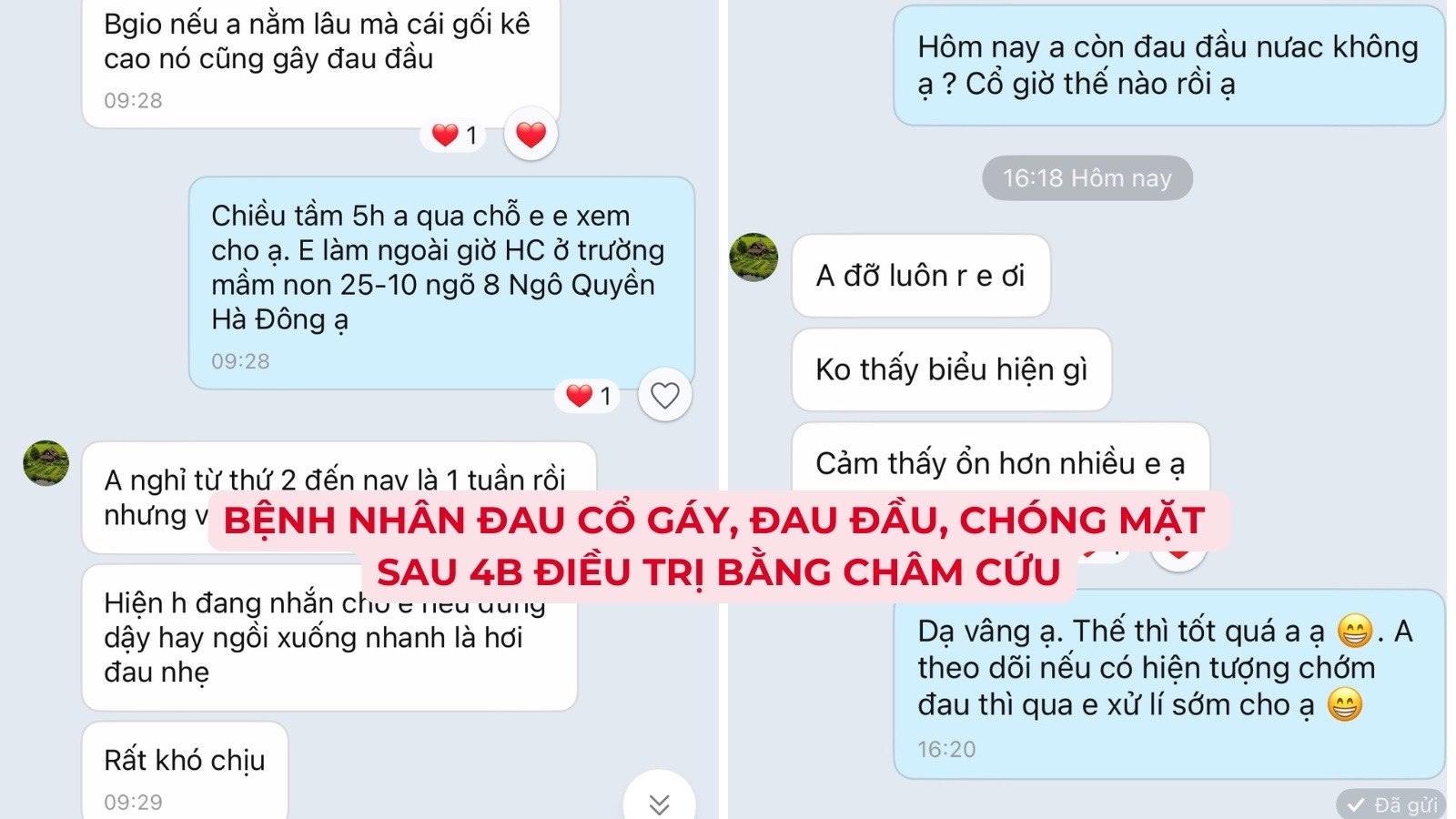 Tin nhắn Zalo bệnh nhân đau cổ gáy, đau đầu, chóng mặt sau 4 buổi điều trị bằng châm cứu